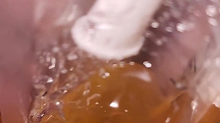 Cripple Problems 101: I Have to Drain Using a Catheter Because My Bladder Was Not Releasing